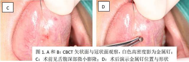“看起来很酷”女孩好奇心驱使打了舌钉没想到…(图2)